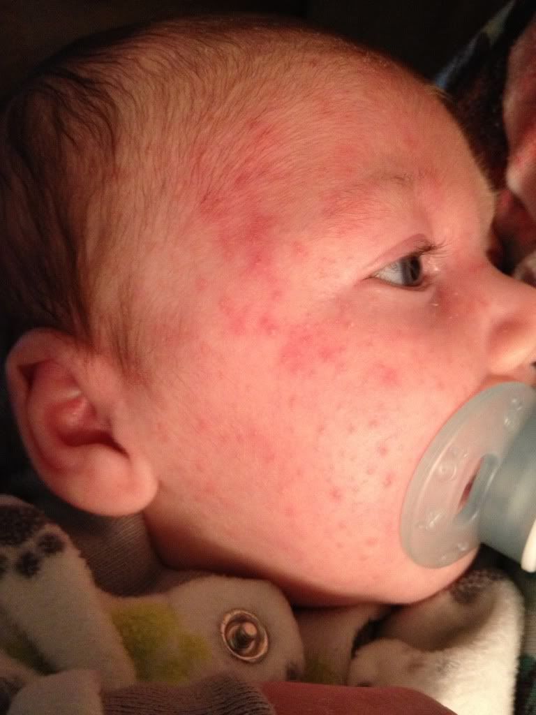Baby Allergic Reaction Rash