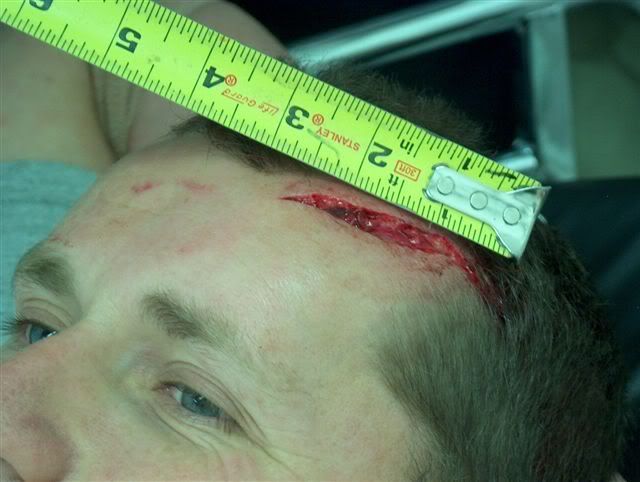Head wound