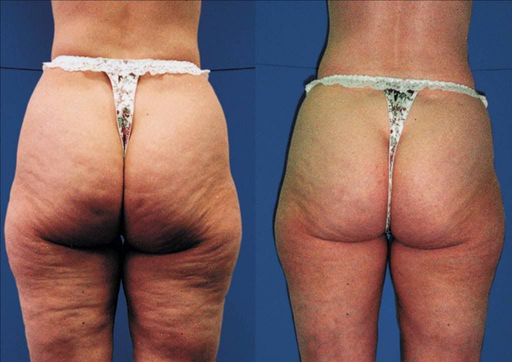 badcellulite.jpg